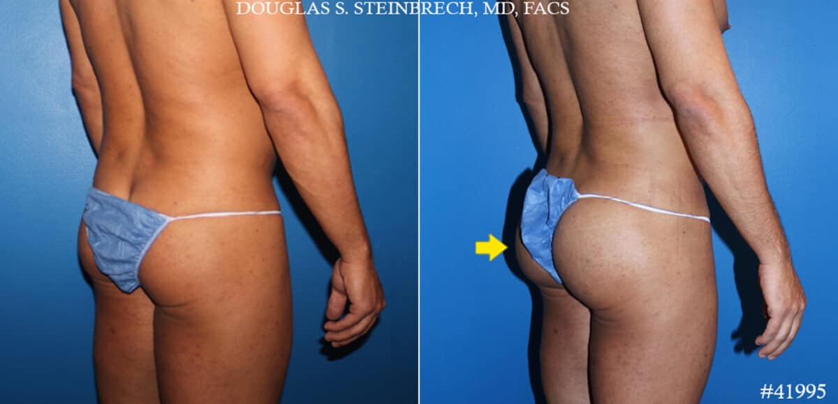 Gluteal Augmentation Before and After Photos in CA, Beverly Hills, Patient 19642