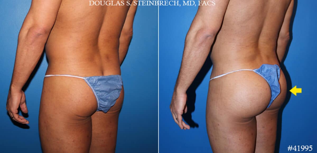 Gluteal Augmentation Before and After Photos in CA, Beverly Hills, Patient 19642