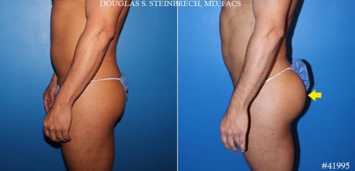 Gluteal Augmentation Before and After Photos in CA, Beverly Hills, Patient 19642