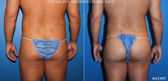 Gluteal Augmentation Before and After Photos in CA, Beverly Hills, Patient 19642