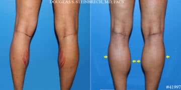 Calf Implants Before and After Photos in CA, Beverly Hills, Patient 19658