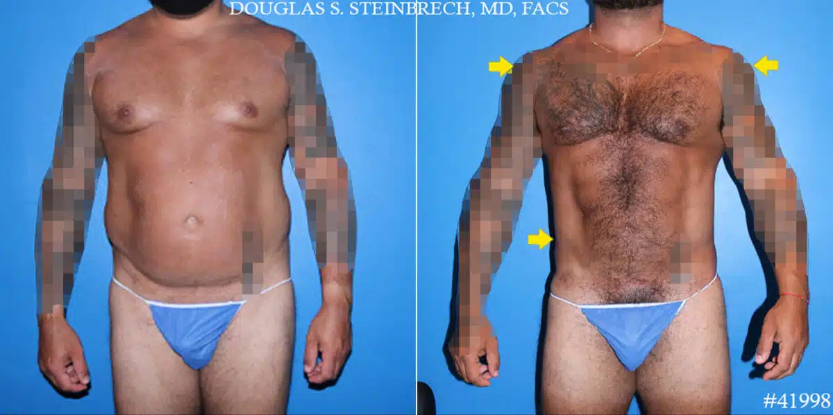 Body Banking Before and After Photos in CA, Beverly Hills, Patient 19662