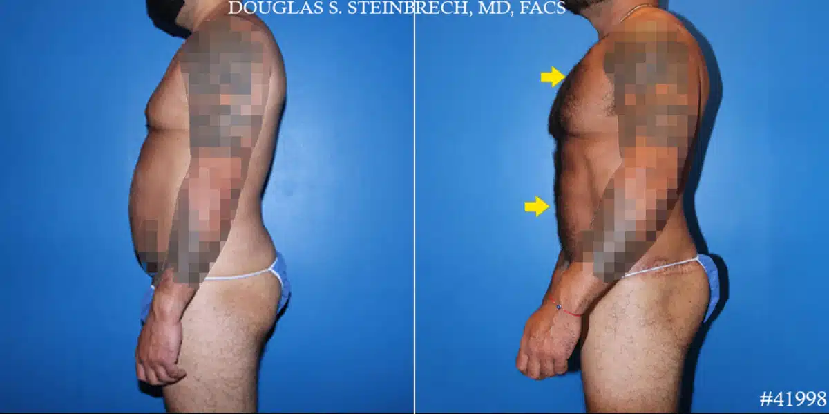 Body Banking Before and After Photos in CA, Beverly Hills, Patient 19662