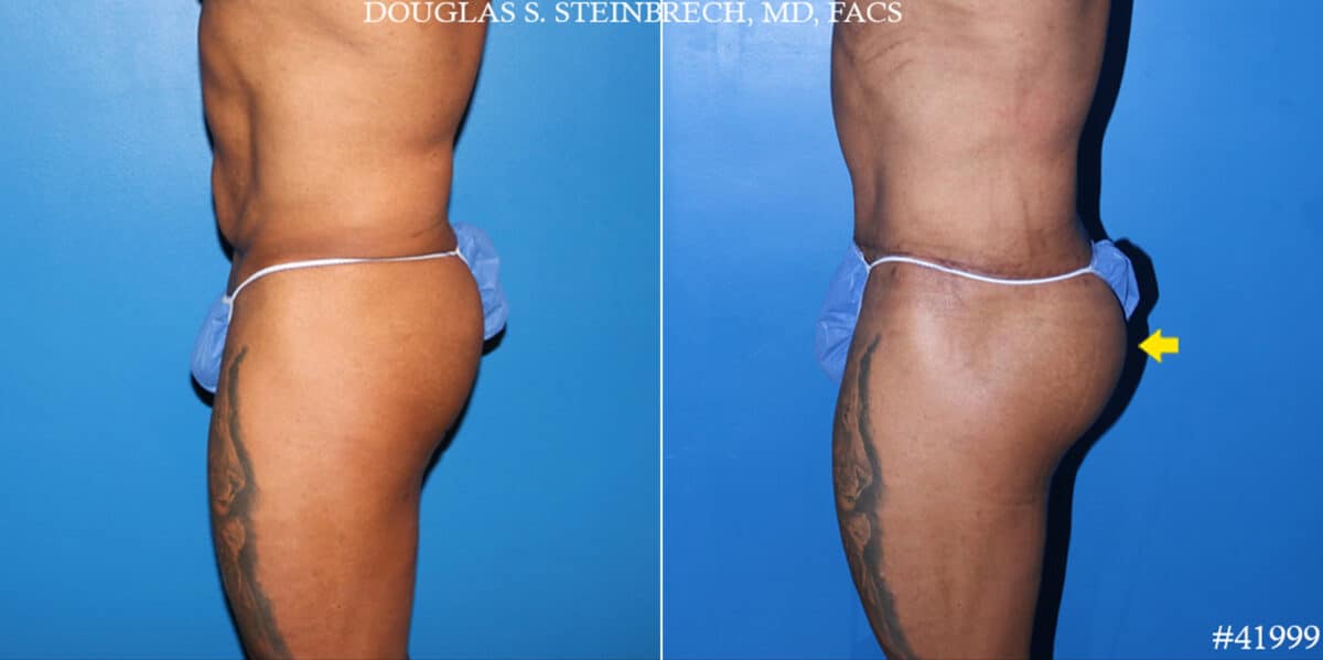 Body Banking Before and After Photos in CA, Beverly Hills, Patient 19672