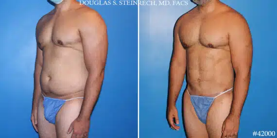 Tummy Tuck for Men  Torso Tuck Surgery