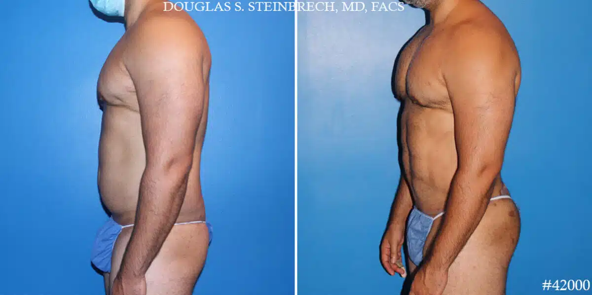 Body Banking Before and After Photos in New York, NY, Patient 19757