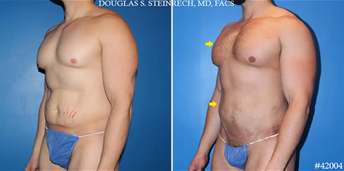 Body Banking Before and After Photos in New York, NY, Patient 19758