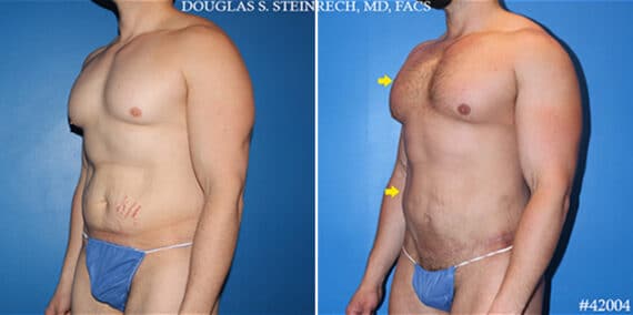Body Banking Before and After Photos in New York, NY, Patient 19758
