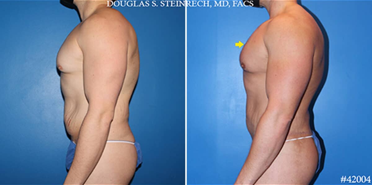 Body Banking Before and After Photos in New York, NY, Patient 19758