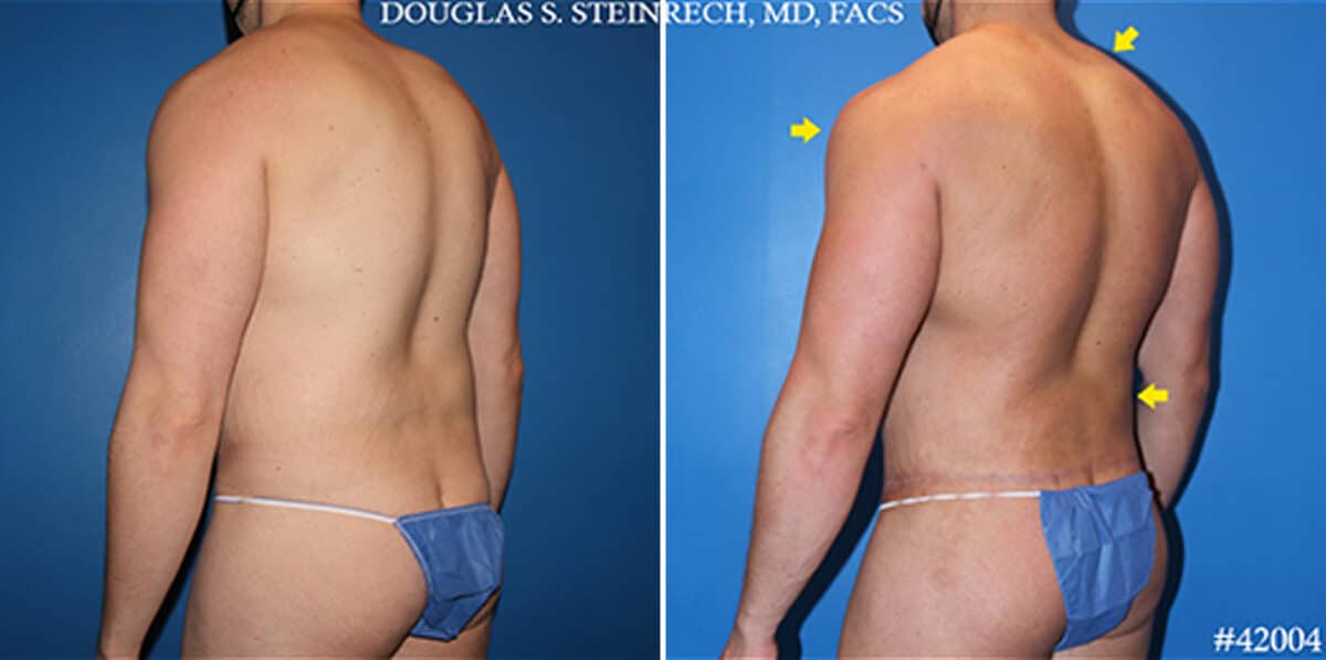 Body Banking Before and After Photos in New York, NY, Patient 19758