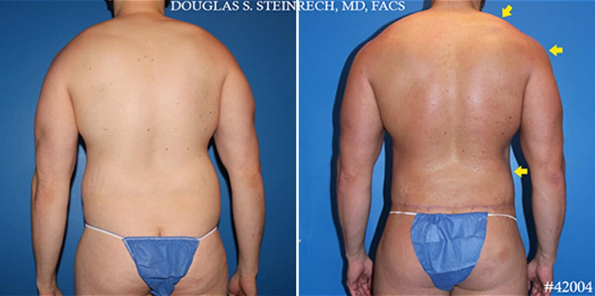 Body Banking Before and After Photos in New York, NY, Patient 19758