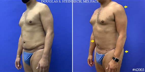 Body Banking Photos - Page 2 of 6 - Dr. Douglas Steinbrech