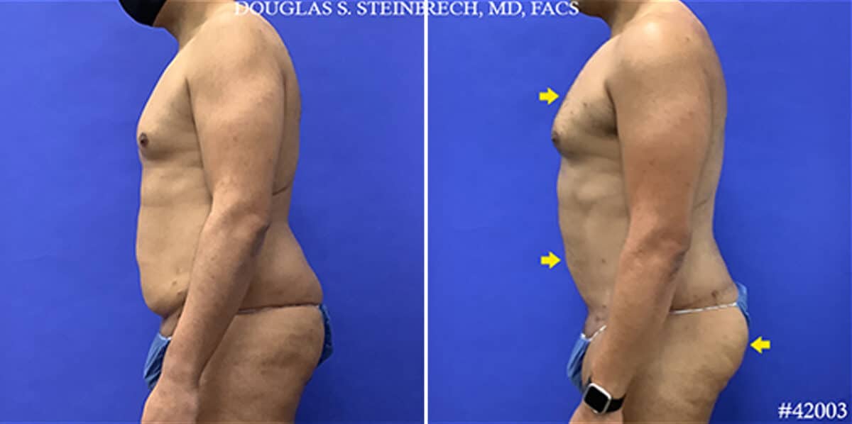 Body Banking Before and After Photos in New York, NY, Patient 19783