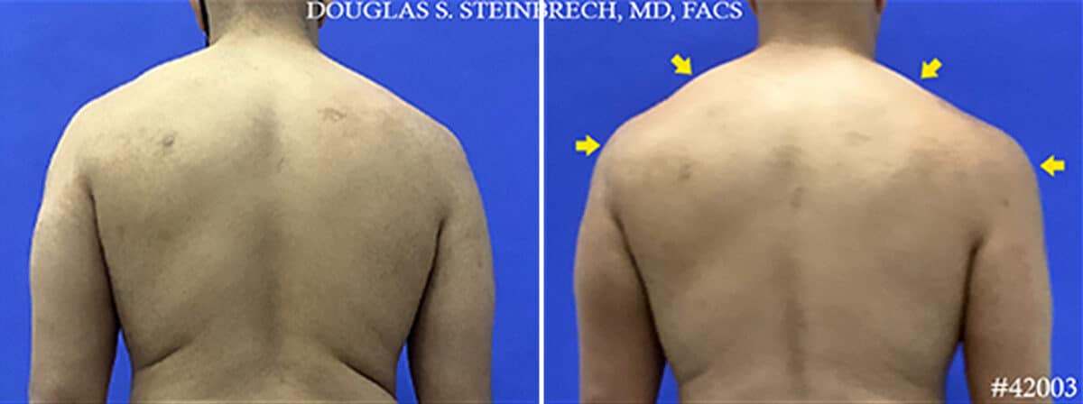 Body Banking Before and After Photos in New York, NY, Patient 19783