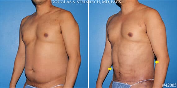 Body Banking Before and After Photos in New York, NY, Patient 19798