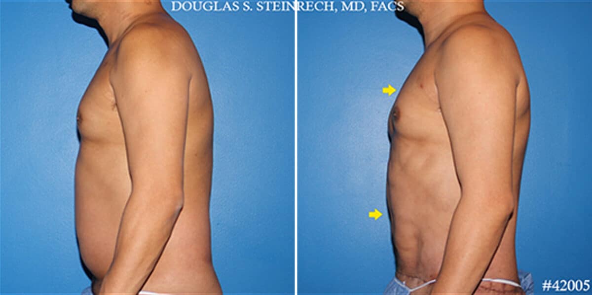 Body Banking Before and After Photos in New York, NY, Patient 19798