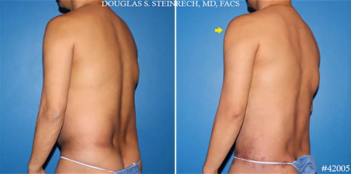 Body Banking Before and After Photos in New York, NY, Patient 19798