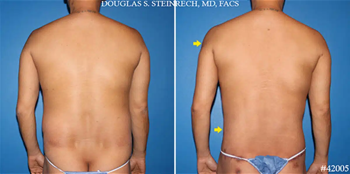 Body Banking Before and After Photos in New York, NY, Patient 19798