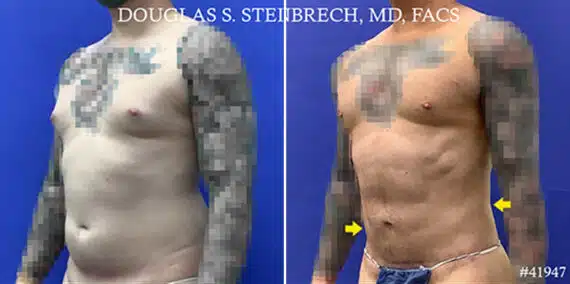 Body Banking Before and After Photos in New York, NY, Patient 19816