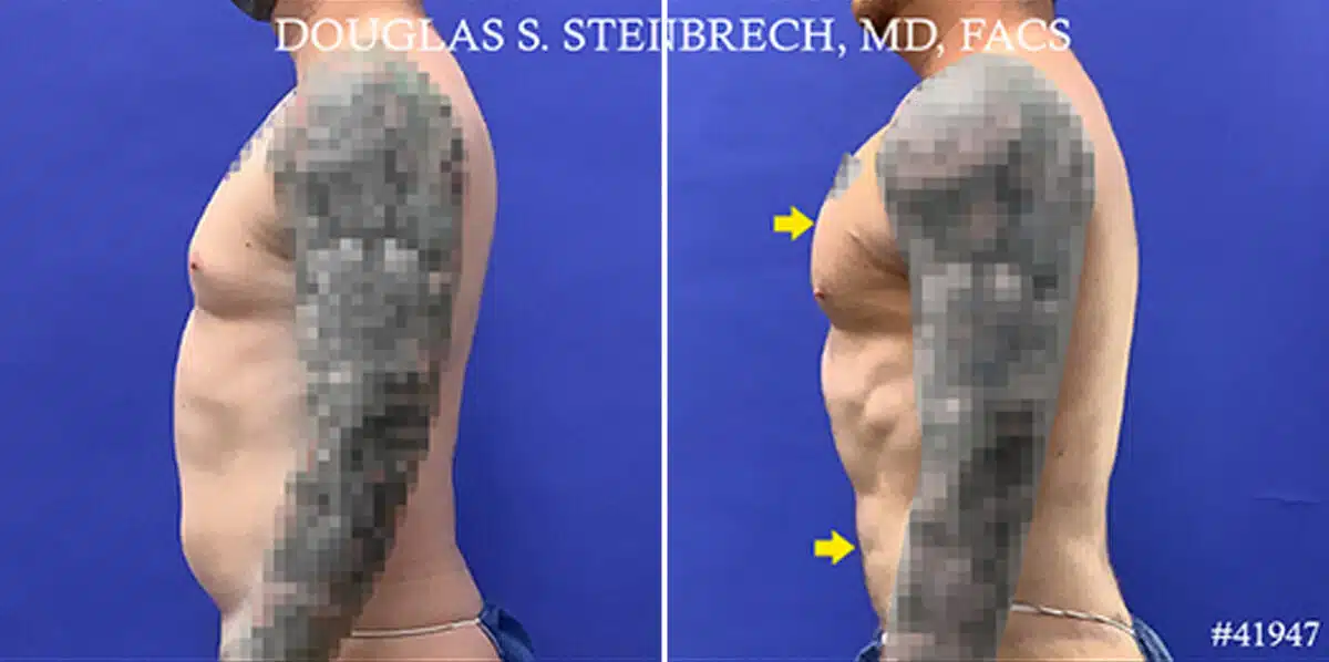 Body Banking Before and After Photos in New York, NY, Patient 19816