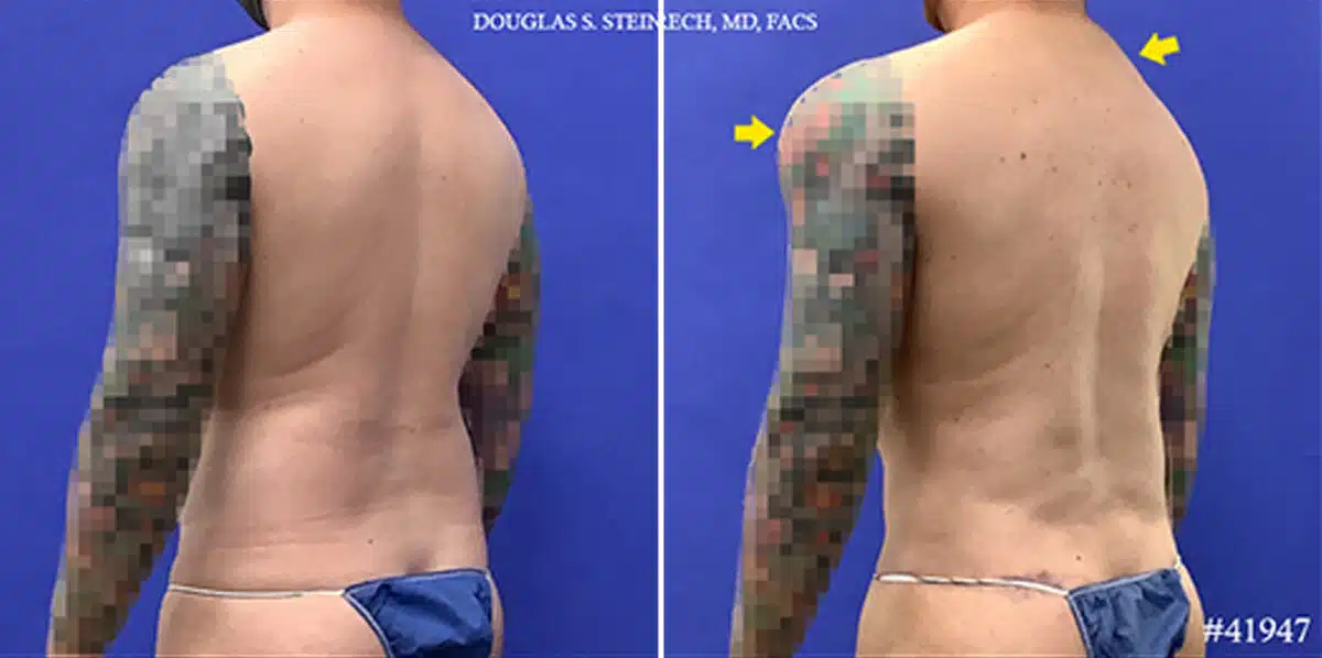 Body Banking Before and After Photos in New York, NY, Patient 19816