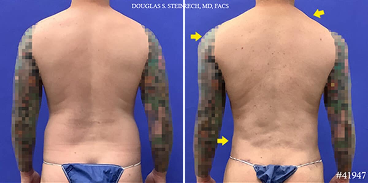 Body Banking Before and After Photos in New York, NY, Patient 19816