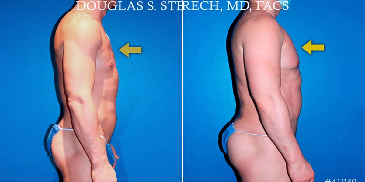 Body Banking Before and After Photos in New York, NY, Patient 17374