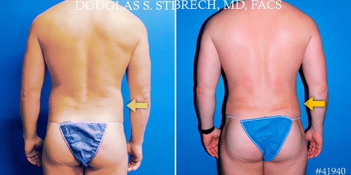 Body Banking Before and After Photos in New York, NY, Patient 17374
