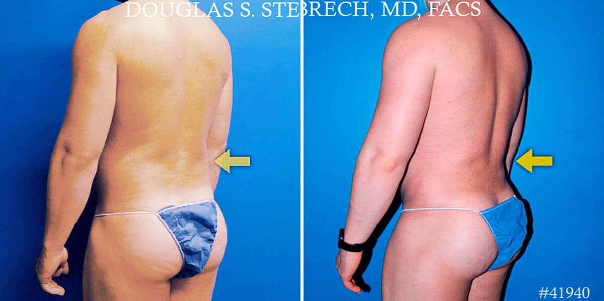Body Banking Before and After Photos in New York, NY, Patient 17374