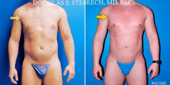 Body Banking Before and After Photos in New York, NY, Patient 17374