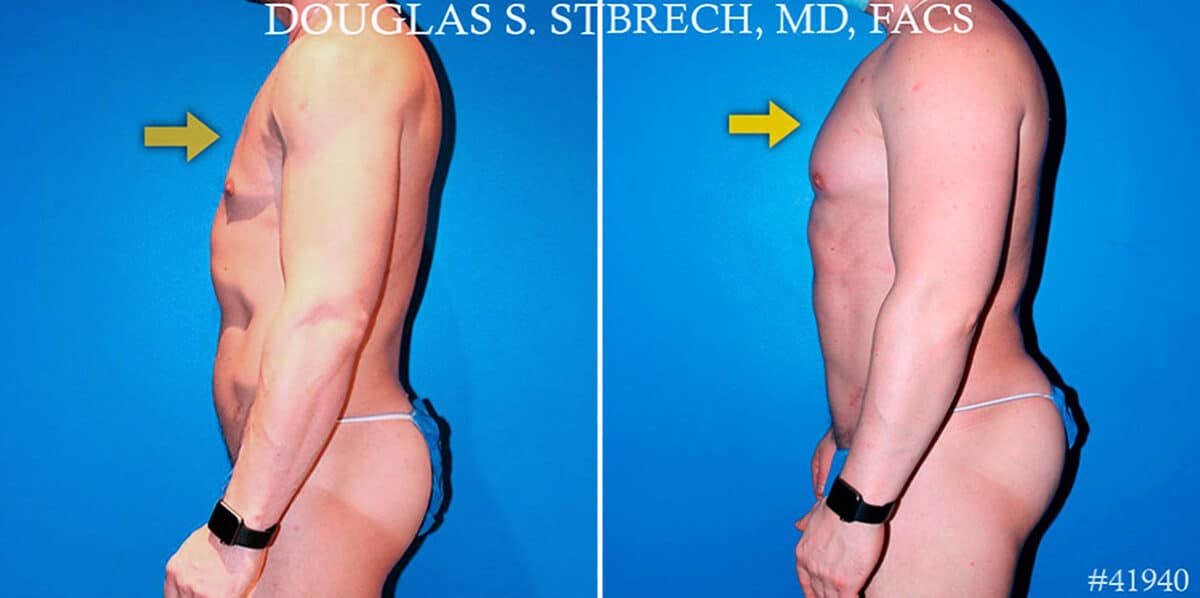 Body Banking Before and After Photos in New York, NY, Patient 17374