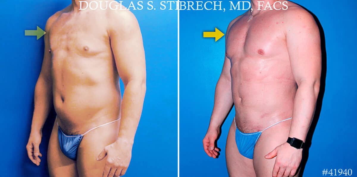 Body Banking Before and After Photos in New York, NY, Patient 17374