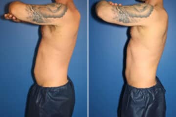 Coolsculpting Before and After Photos in New York, NY, Patient 10855