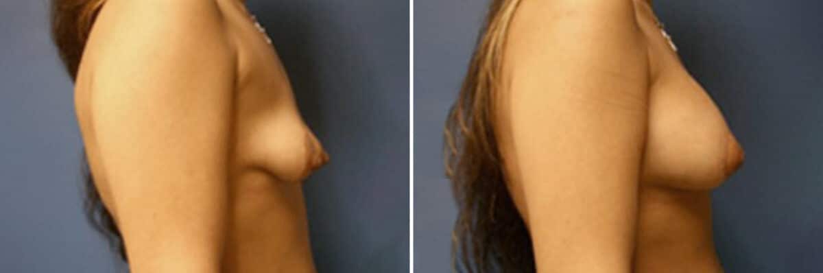 Specialty Breast Augmentation Before and After Photos in New York, NY, Patient 10863