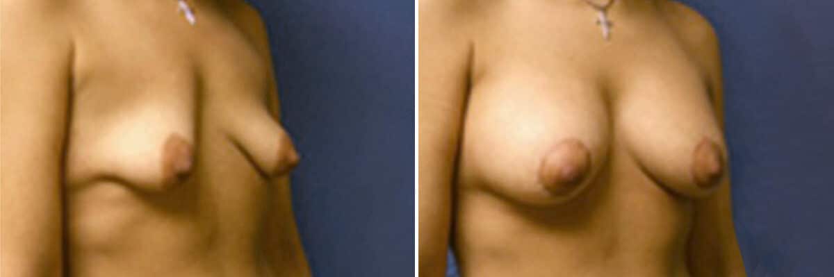 Specialty Breast Augmentation Before and After Photos in New York, NY, Patient 10863