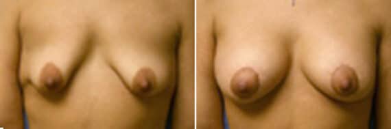 Specialty Breast Augmentation Before and After Photos in New York, NY, Patient 10863