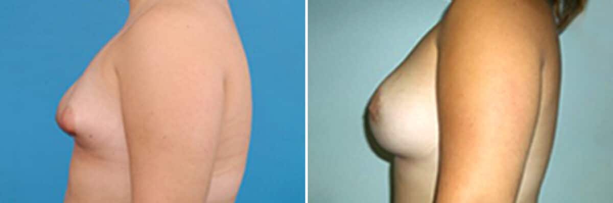 Specialty Breast Augmentation Before and After Photos in New York, NY, Patient 10883