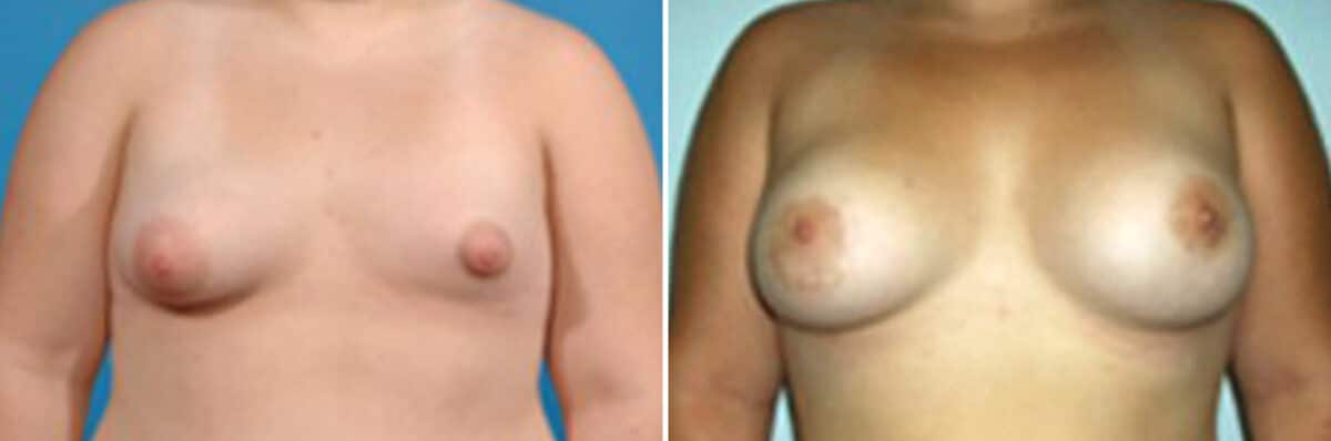 Specialty Breast Augmentation Before and After Photos in New York, NY, Patient 10883