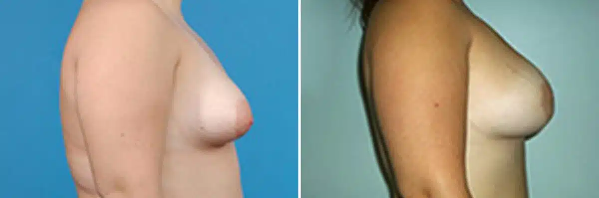 Specialty Breast Augmentation Before and After Photos in New York, NY, Patient 10883