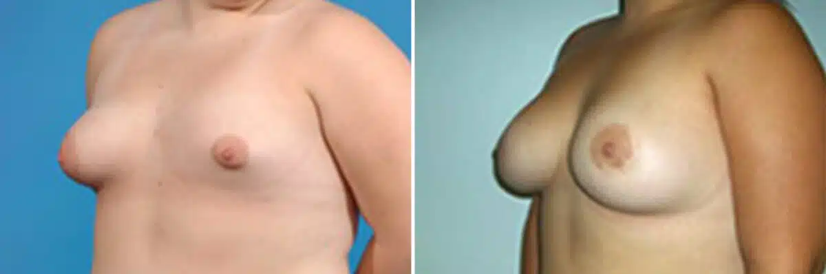 Specialty Breast Augmentation Before and After Photos in New York, NY, Patient 10883