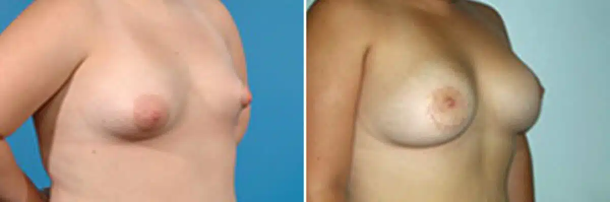 Specialty Breast Augmentation Before and After Photos in New York, NY, Patient 10883