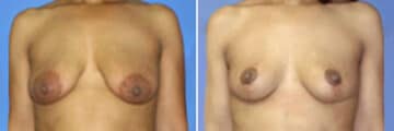 Breast Lift Before and After Photos in New York, NY, Patient 10951