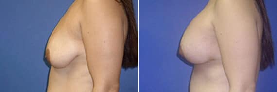 Breast Lift Before and After Photos in New York, NY, Patient 10961