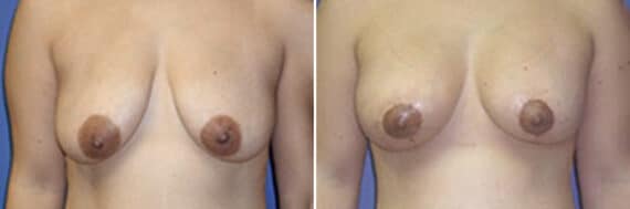 Breast Lift Before and After Photos in New York, NY, Patient 10961