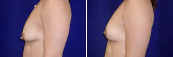 Breast Lift Before and After Photos in New York, NY, Patient 10967