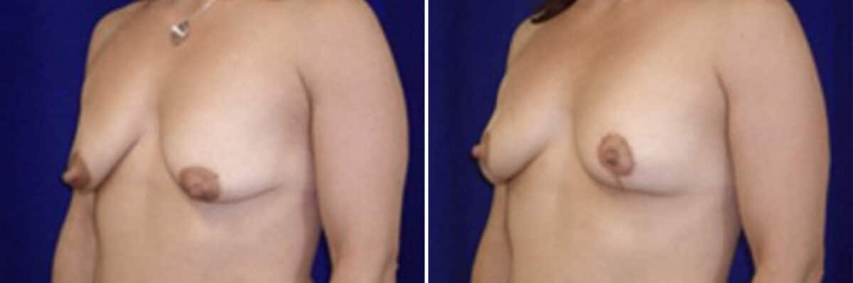 Breast Lift Before and After Photos in New York, NY, Patient 10973