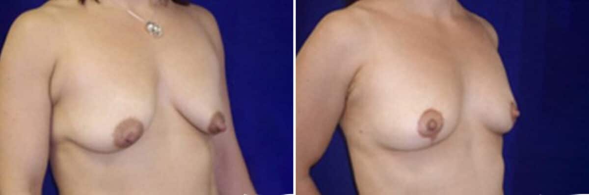 Breast Lift Before and After Photos in New York, NY, Patient 10973