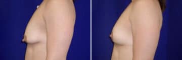 Breast Lift Before and After Photos in New York, NY, Patient 10973