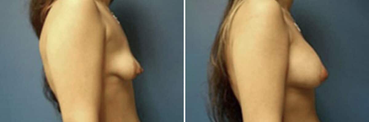 Breast Lift Before and After Photos in New York, NY, Patient 10977