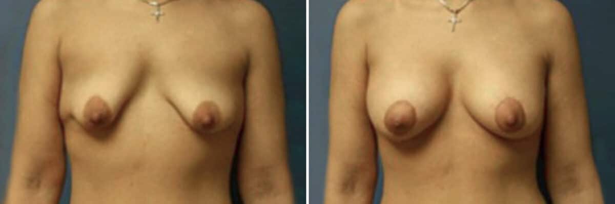 Breast Lift Before and After Photos in New York, NY, Patient 10977